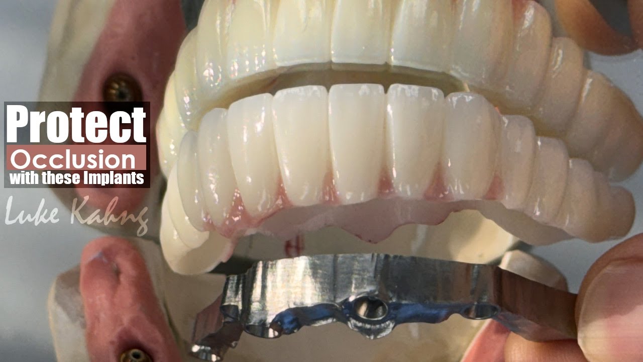 Different Full-Mouth Implant Option for Protecting Occlusion