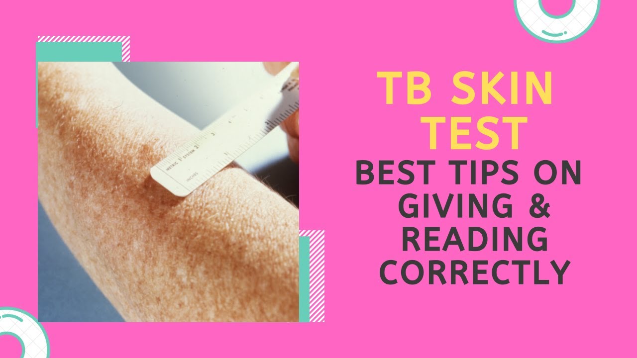TB Skin Test: What Does it Mean When There isn't a Wheal After it is Given? Answer to this and more!