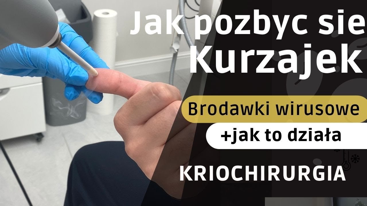 Jak skutecznie  pozbyć kurzajek?