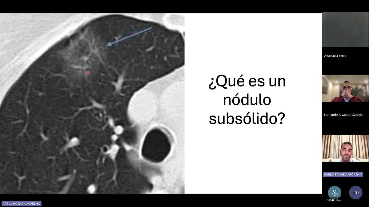 Estrategias de manejo quirúrgico en el cáncer pulmonar de célula no pequeña -Estadía IA