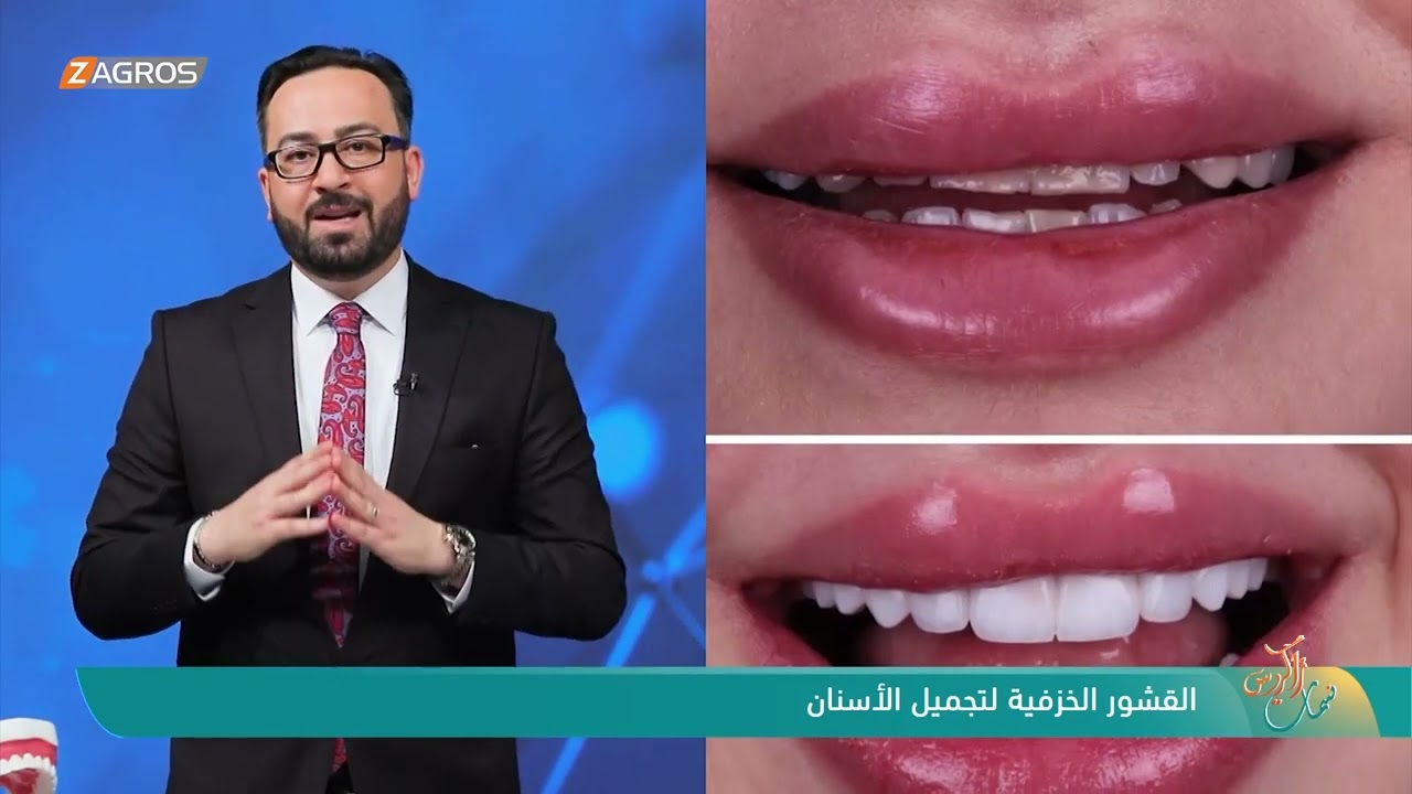 فوائد واستخدامات القشور الخزفية في تجميل الاسنان