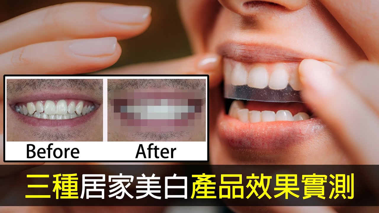 牙齒美白產品效果實測，非業配！Crest 3D 專業型美白牙貼、Opalescence牙托式居家美白、Supersmile美白牙膏&美白筆美白效果大公開｜林榆芩醫生