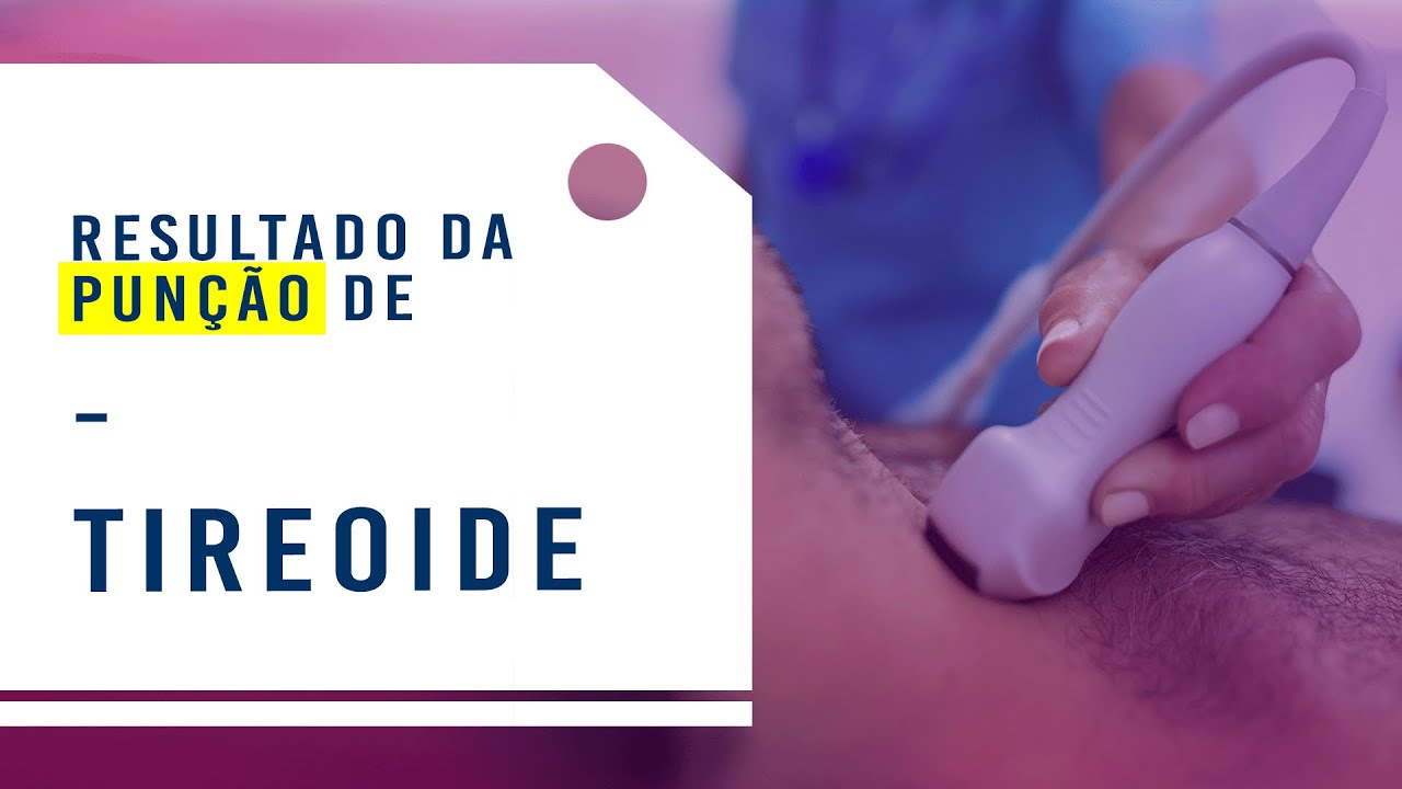 Tireoide: Resultado da punção de tireoide - Dr. Rogério Leite