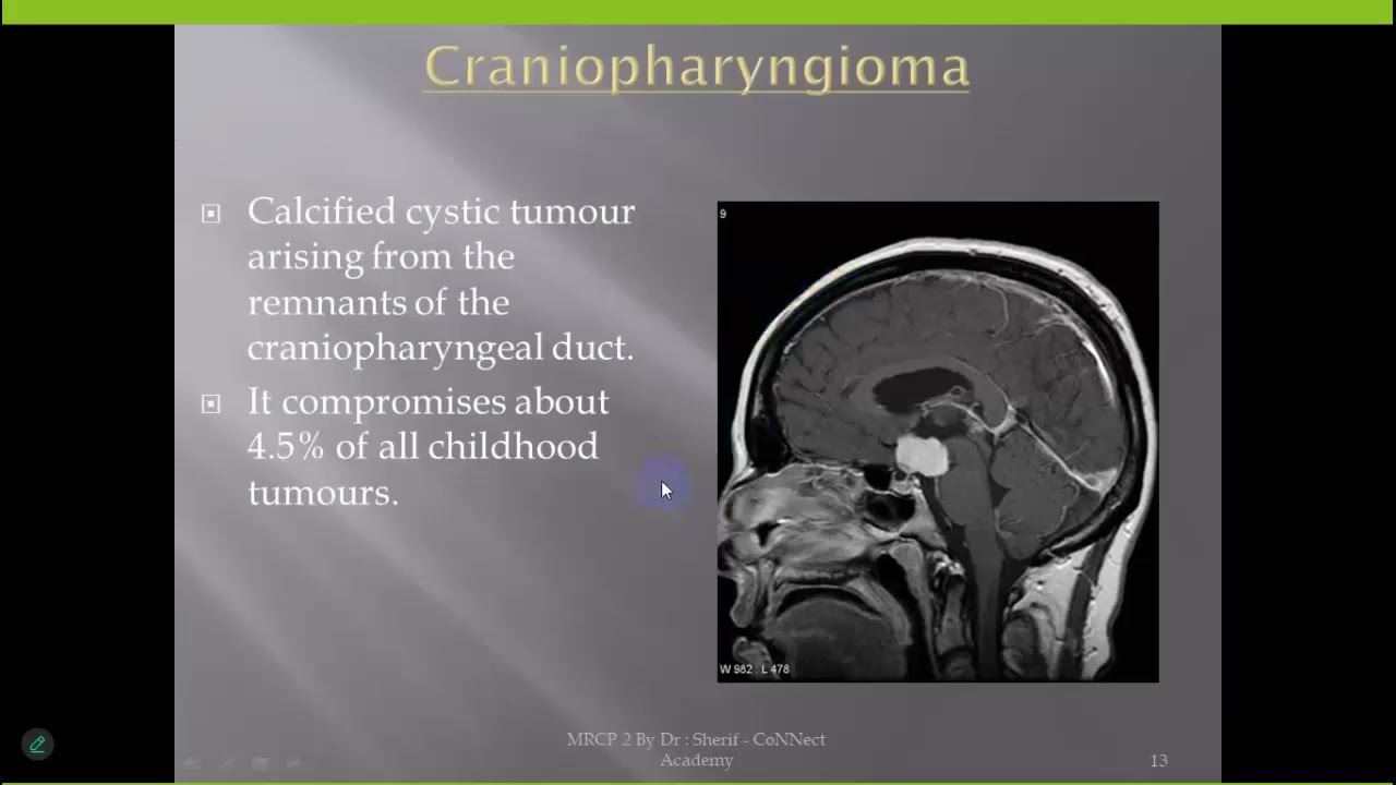 MRCP 2 | أهم Cases في الـ Endocrine… لو فهمتهم، الامتحان هيبقى أسهل بكتير