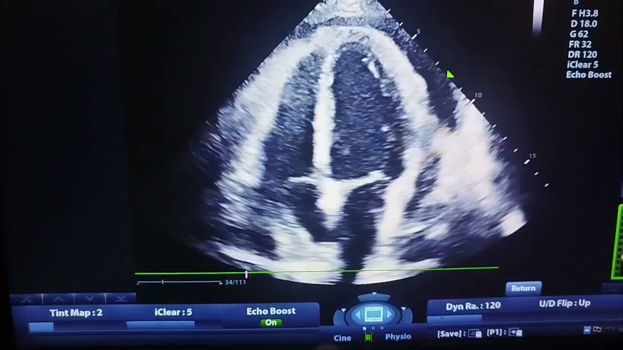 Male patient , 25 y , Addict ,Moderate pericardial Effusion with early signs of cardiac tamponade 