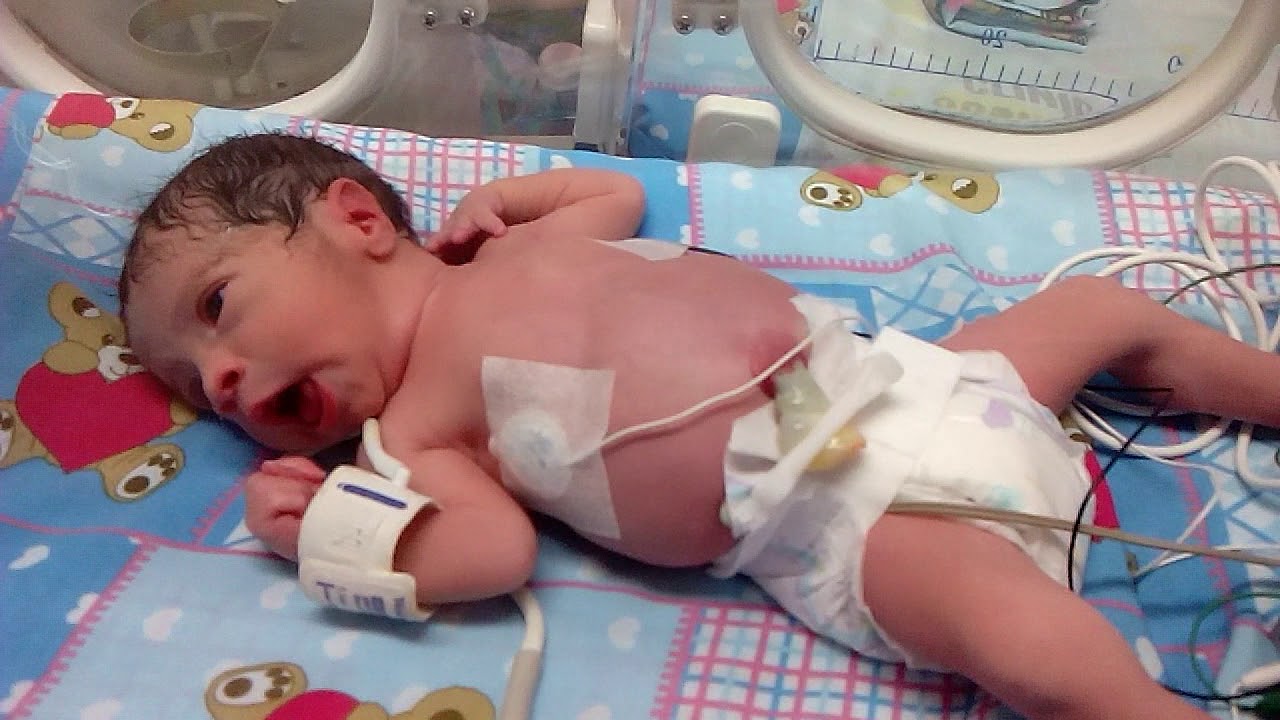 Bebe prematuro de 31 semanas