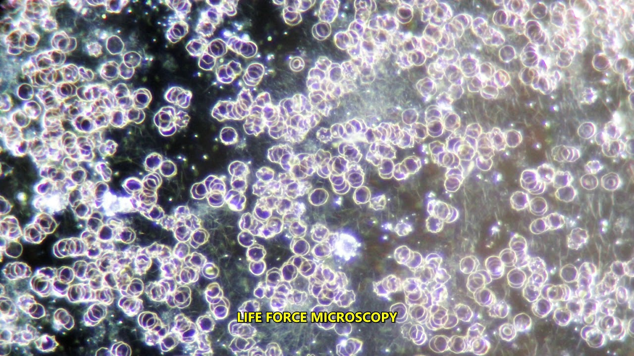 LIVE BLOOD ANALYSIS: FIBRIN SPICULES (
