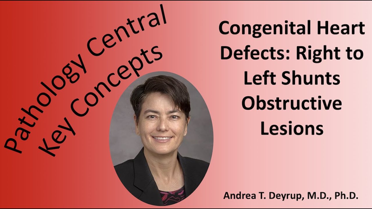Medical Student Pathology: Congenital Heart Disease: Right to Left Shunts/Obstructive Lesions