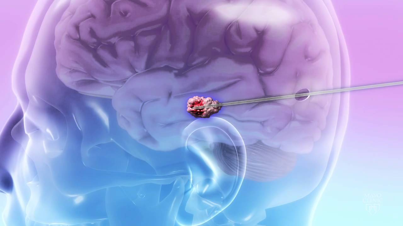 When Breast Cancer Travels to the Brain: Laser Therapy - Mayo Clinic