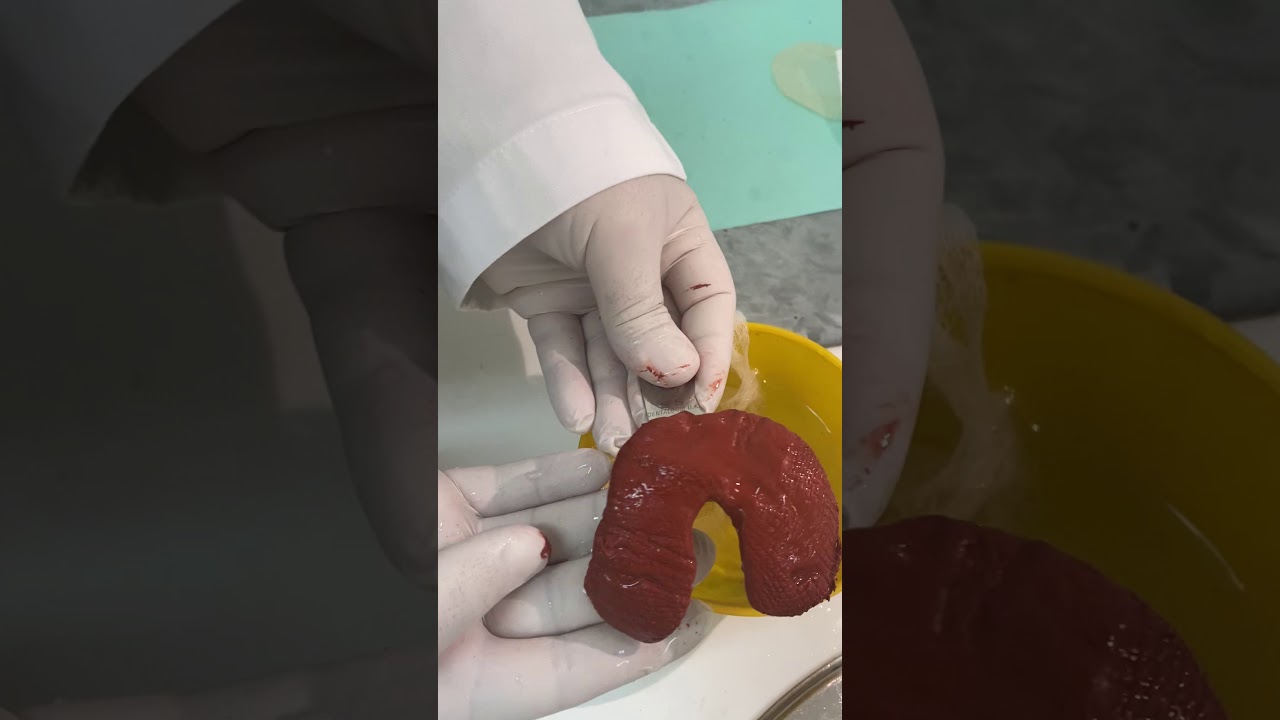 Visit 1: Loading upper stock tray for a patient with a high palatal vault