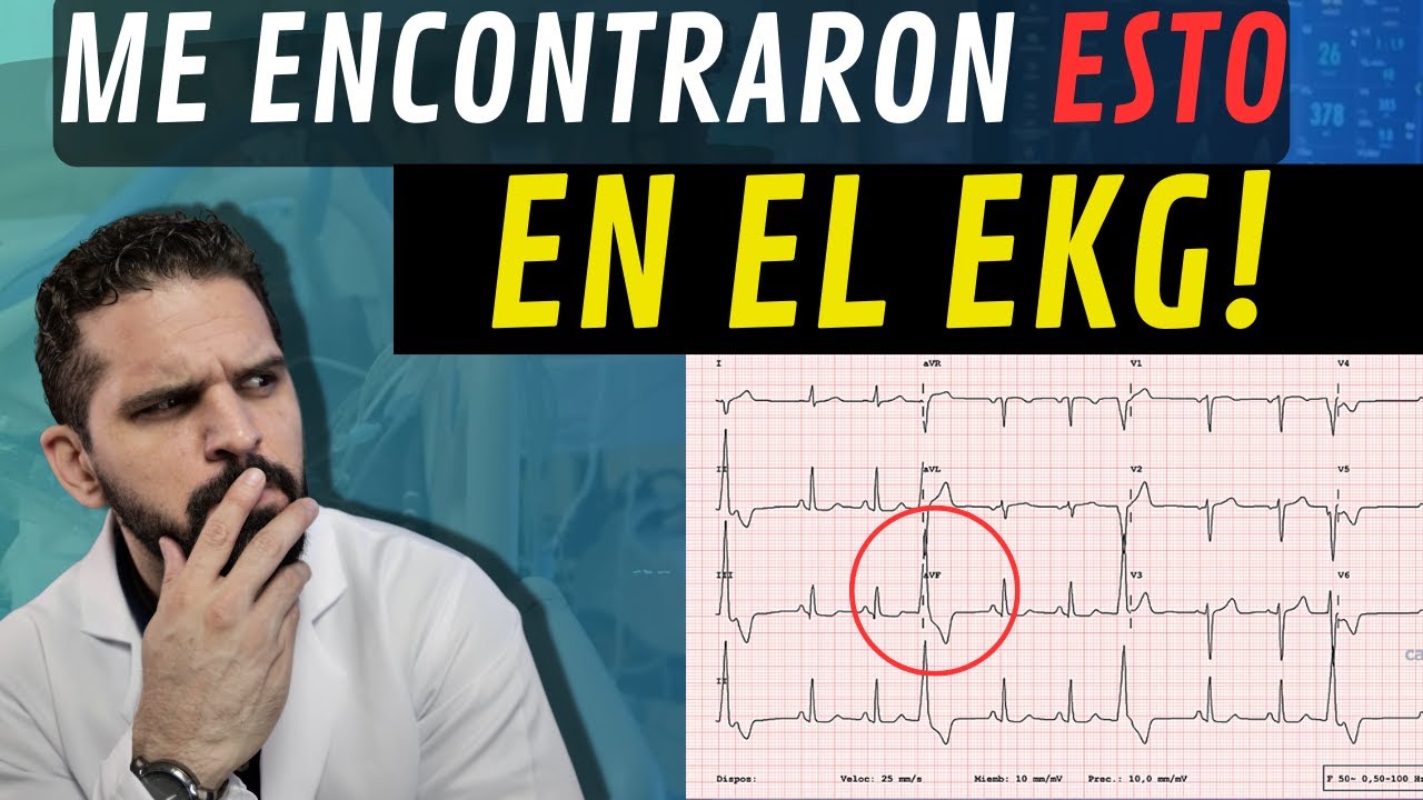 !Descifrando tu ECG! : Entendiendo los Resultados de tu Electrocardiograma 🤔💯