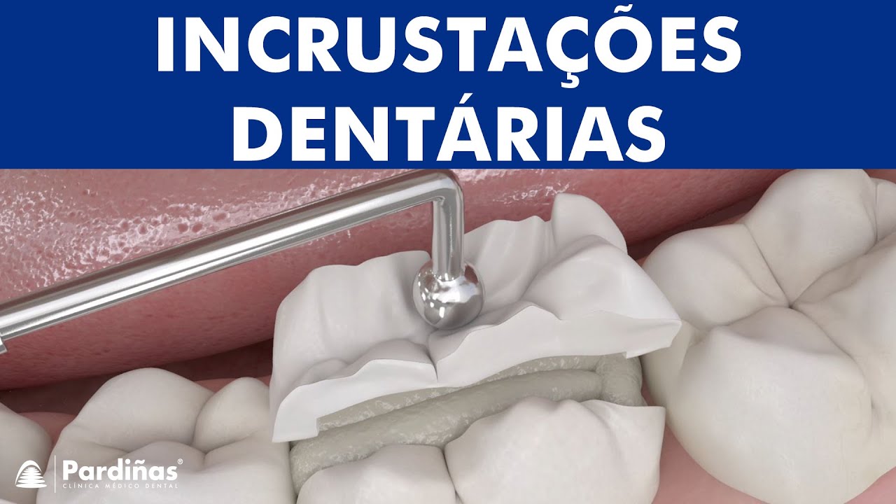 Incrustações dentárias ©