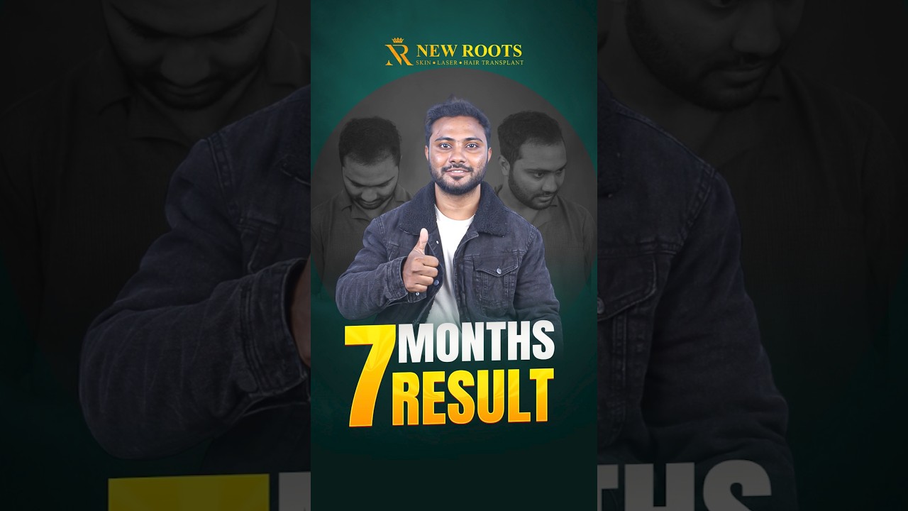 3100 Grafts Hair Transplant in Bangladesh | Cost & Best Results 