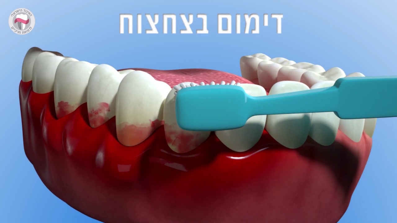 מהי מחלת חניכיים? סימנים