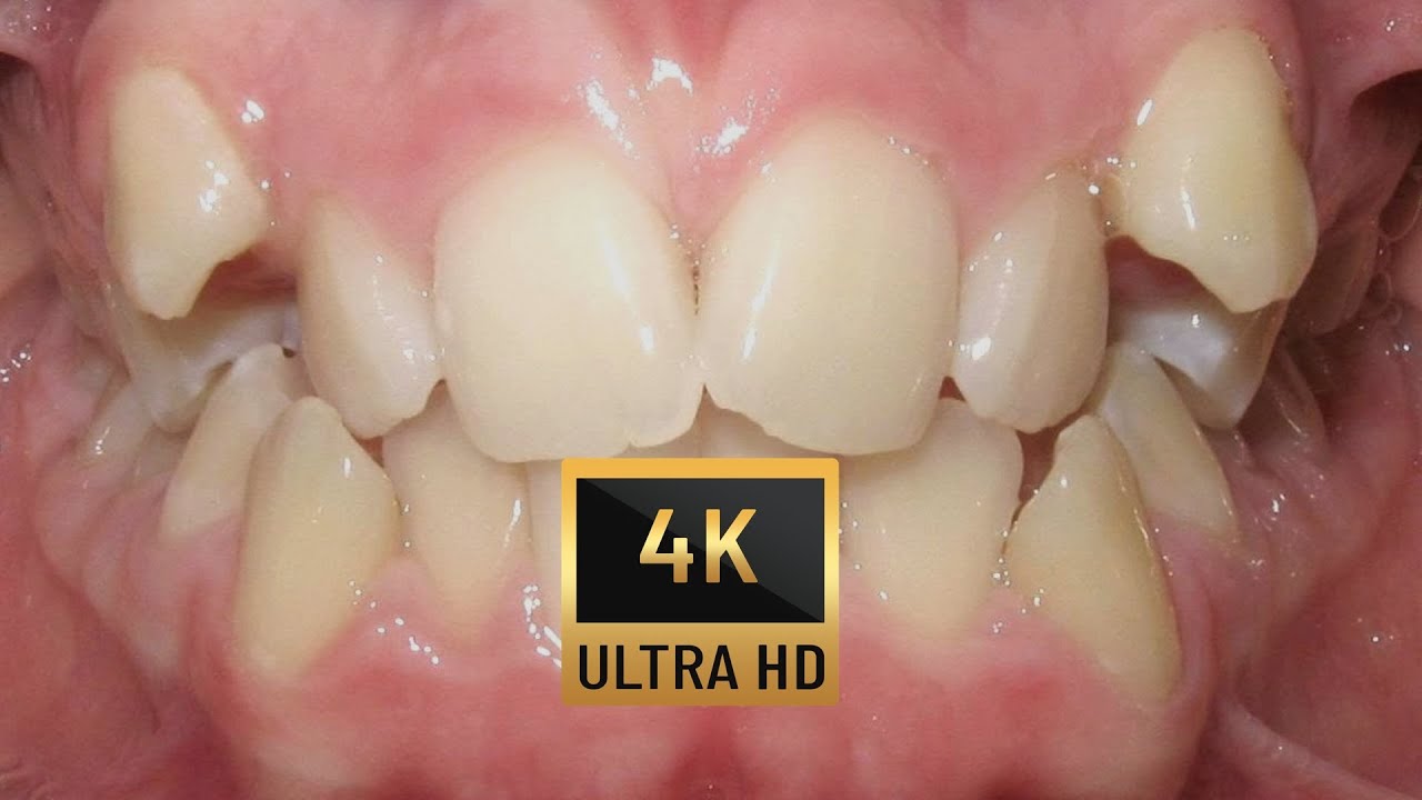 HOW #BRACES WORK - #TIMELAPSE of ECTOPIC CANINES - non extraction #Orthodontics