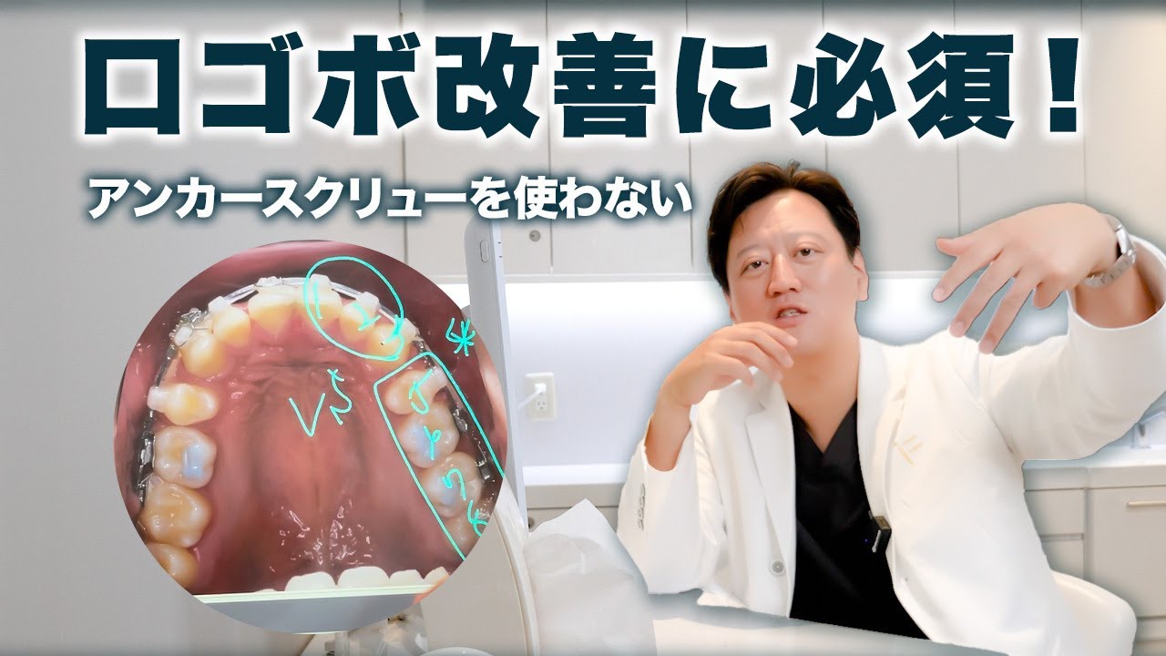 【Eラインの改善】矯正治療は痛い？アンカースクリューを使用しないで口ゴボの矯正はできるのか徹底解説【審美歯科 歯列矯正 歯並び】