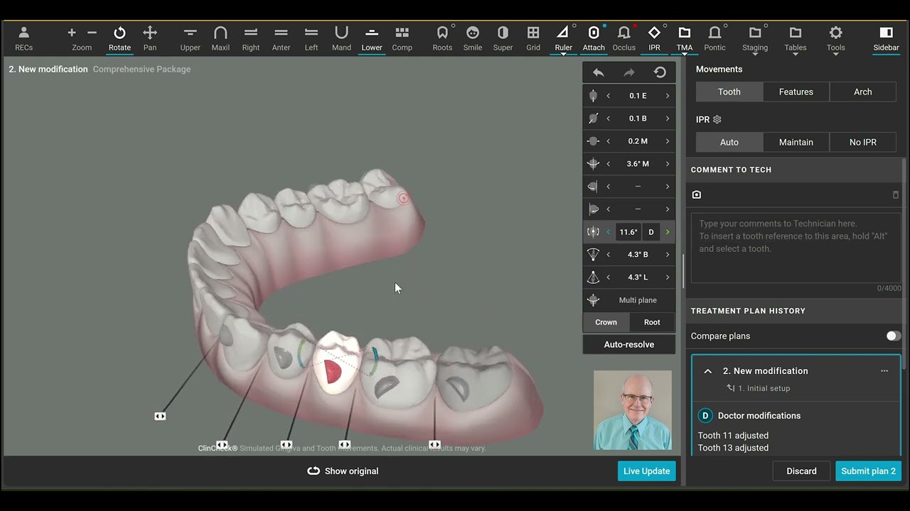 3D Controls: How to Adjust Mesial-Distal Angulation Movements