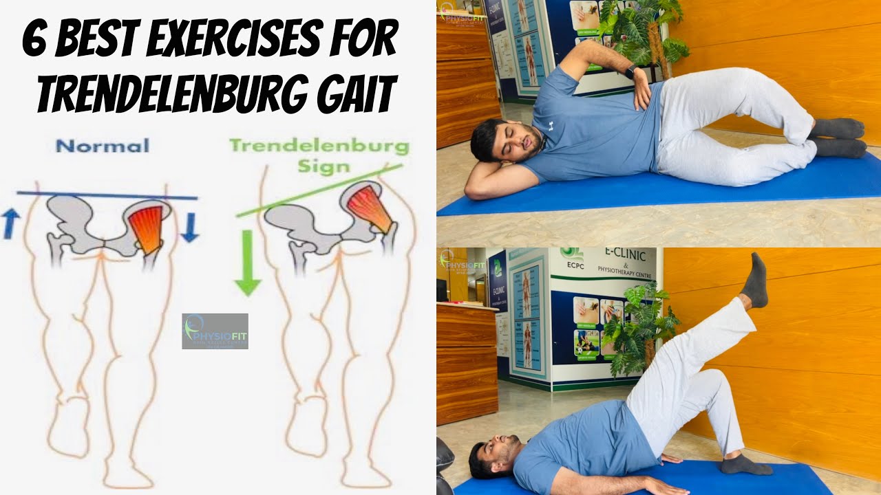 These Exercises Correct Your Abnormal Walking Pattern (Trendelenburg Gait) @PhysiofitByDrMajid