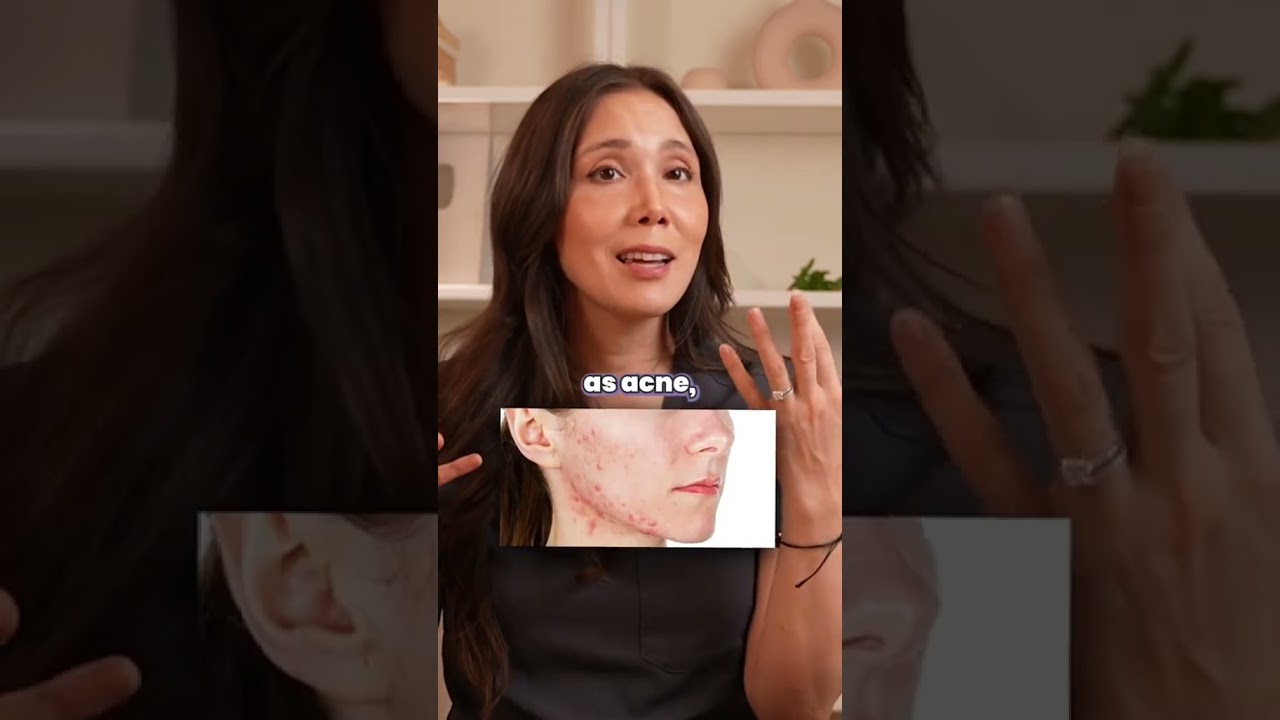Can Accutane Help My Hormonal Acne From PCOS?