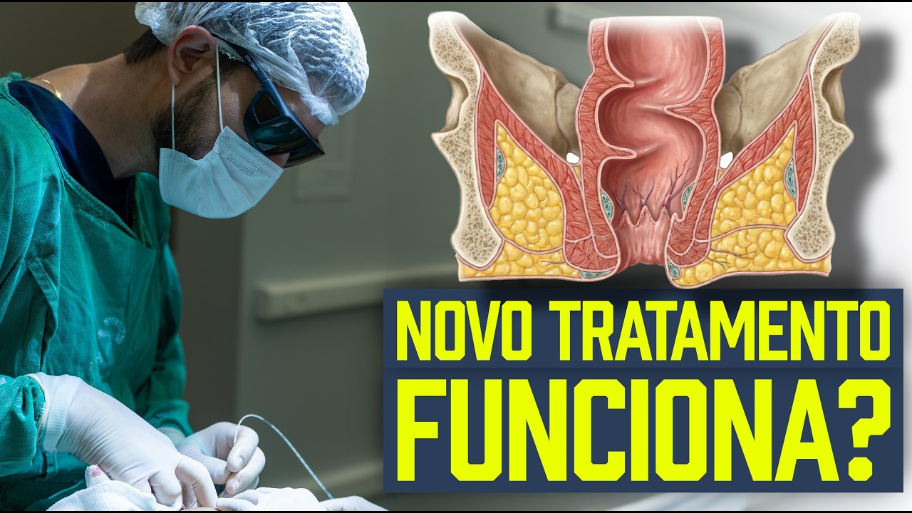 Fístula anal: laser, ultrassom e o que realmente faz diferença no tratamento