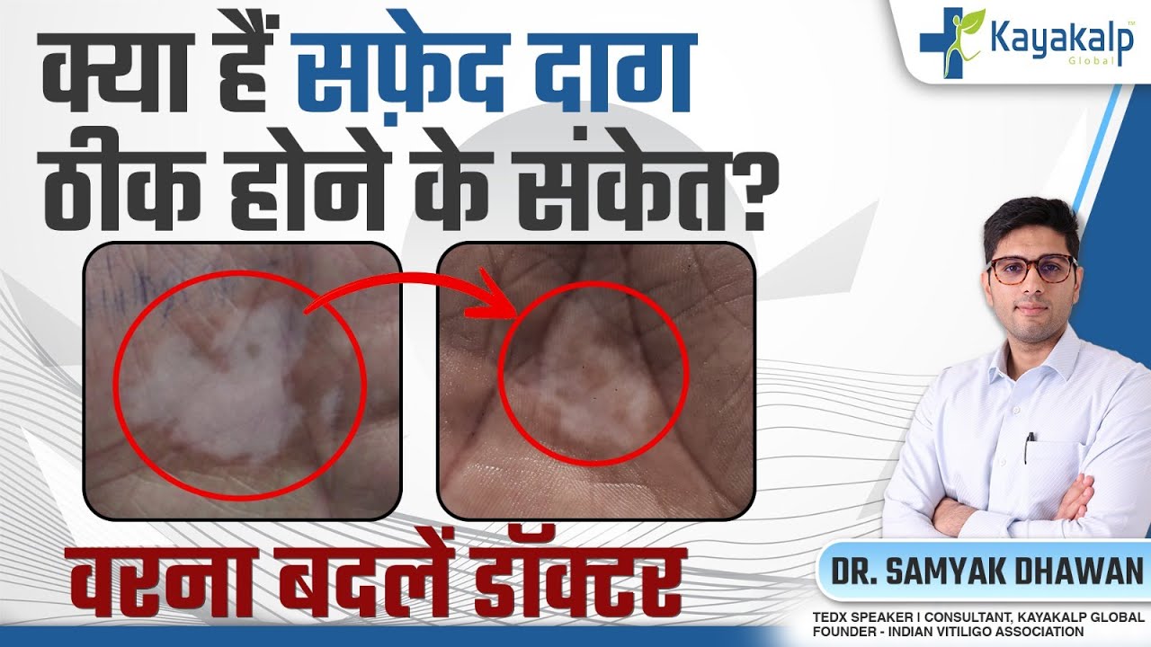 क्या हैं Vitiligo से Recovery के संकेत? | Vitiligo (Safed Daag) Recovery Signs | Kayakalp Global