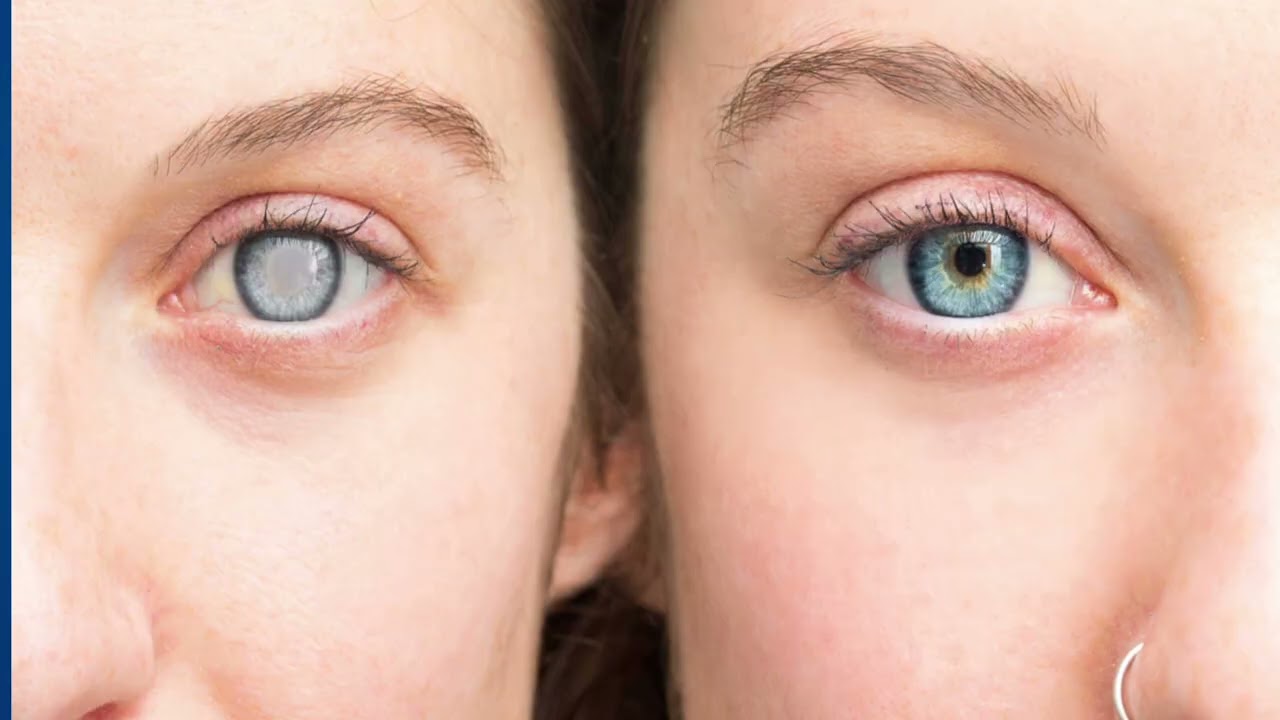 أنواع و أسعار عدسات الزرع داخل العين مع عملية المياه البيضاء ٢٠٢٥