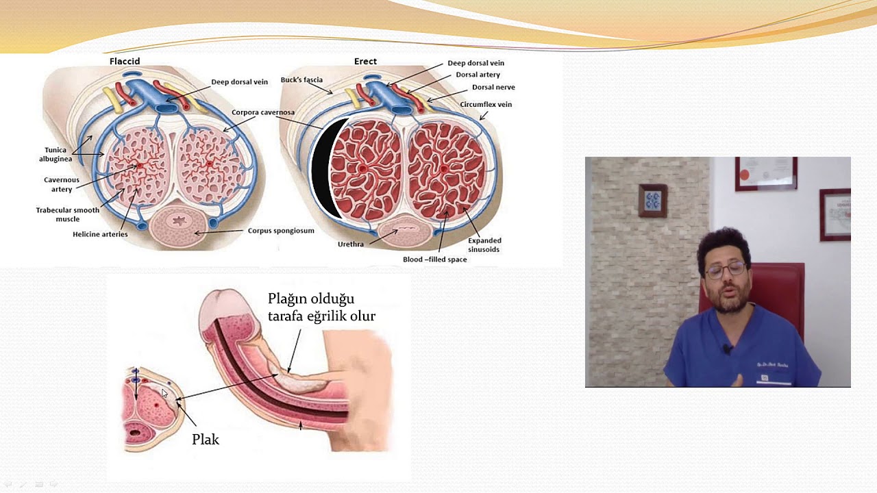 Penis Eğriliği-1 Peyronie Hastalığı Nedir?