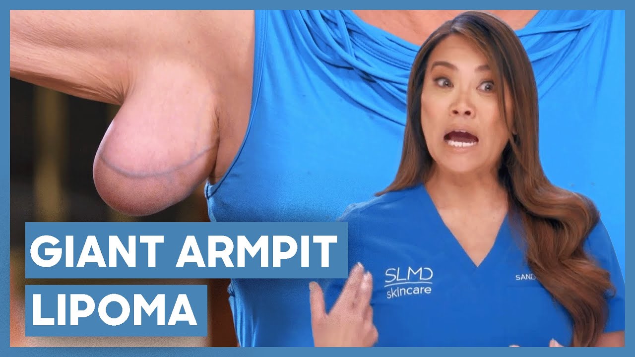 Dr. Lee Removes A GIANT Armpit Lipoma | Dr Pimple Popper | Love Medical