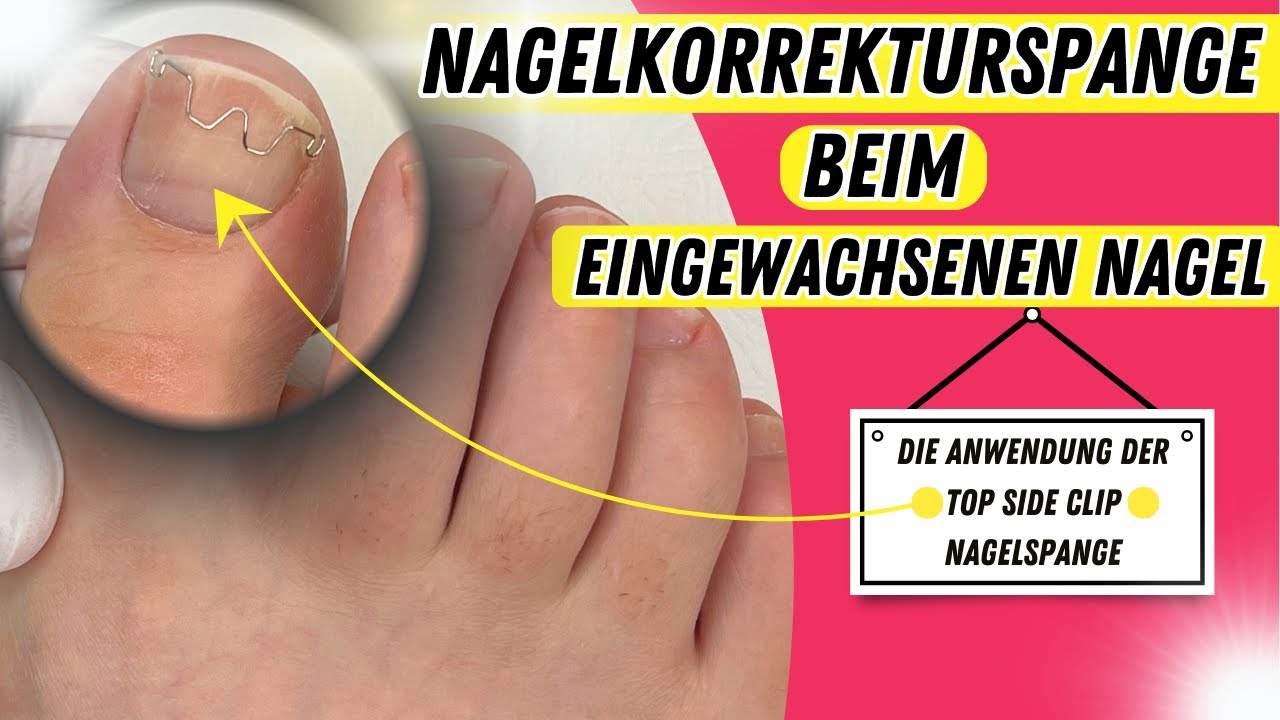 NAGELSPANGE Top Side Clip für EINGEWACHSENE NÄGEL und ROLLNÄGEL! | Podologie | Nagelkorrekturspange
