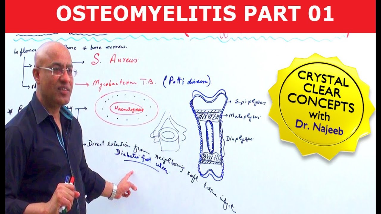 Osteomyelitis | Symptoms & Causes🩺