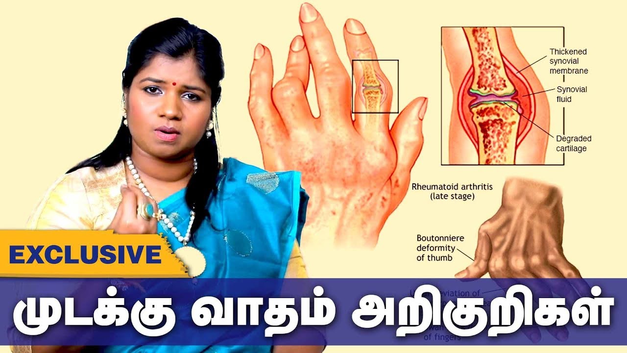 முடக்கு வாதம் அறிகுறிகள்!!! தீர்வு என்ன? | arthritis Siddha Treatment | Tamil health tips