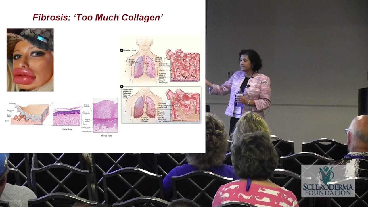 2016 New Orleans - Fibrosis:  The Ugly Side of Collagen