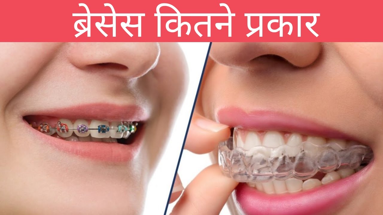 Types of #Braces दांतों के तार, कितने प्रकार के होतें हैं, ब्रेसेस तार कौनसे लगवायें,क्या ध्यान रखें