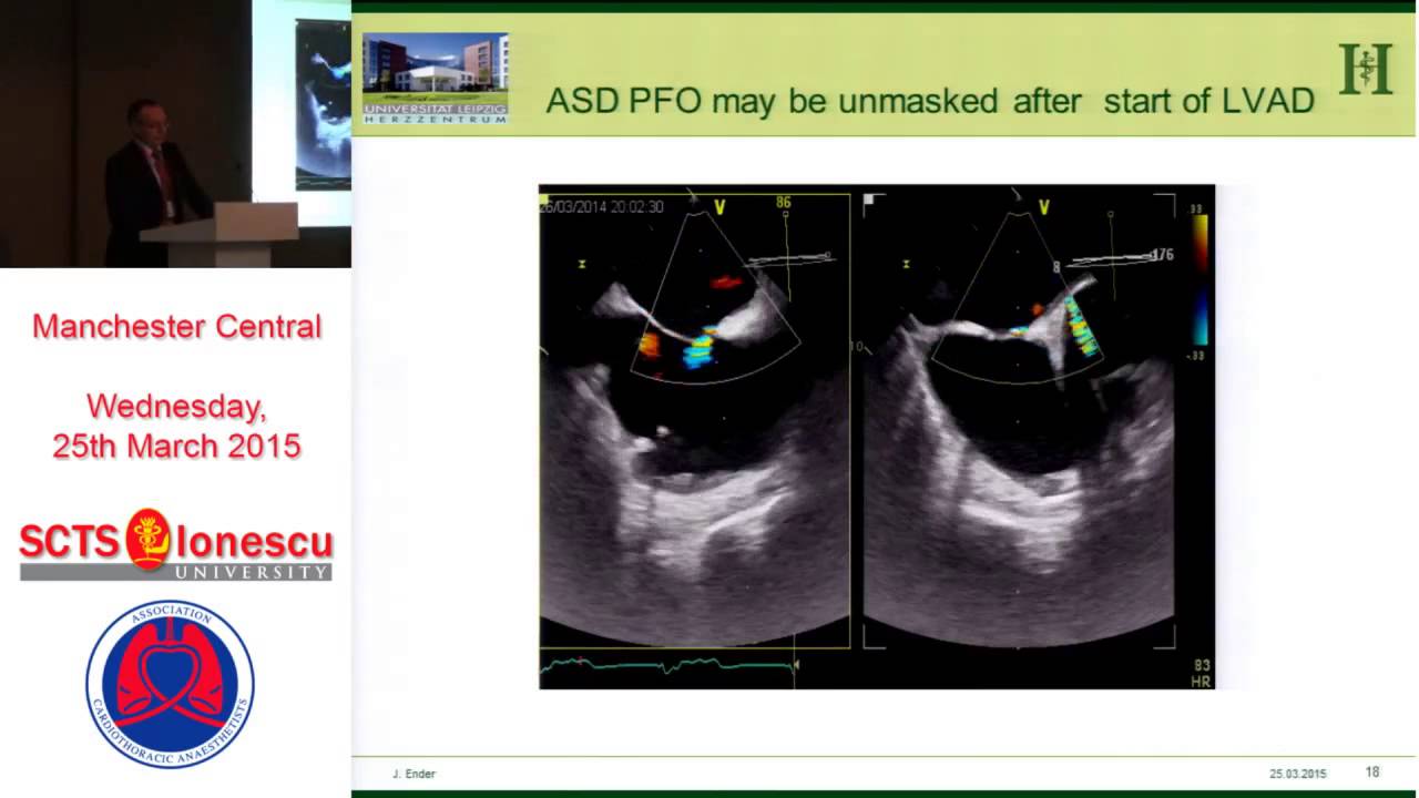 Transoesophageal echocardiography in Mechanical Assist