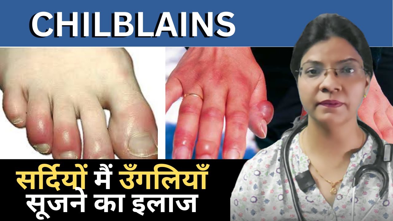 CHILBLAINS I सर्दियों मैं उँगलियाँ सूजने का इलाज – DR. ANAND