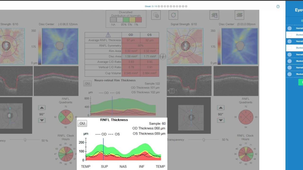 INTERPRET Glaucoma: RNFL Graph