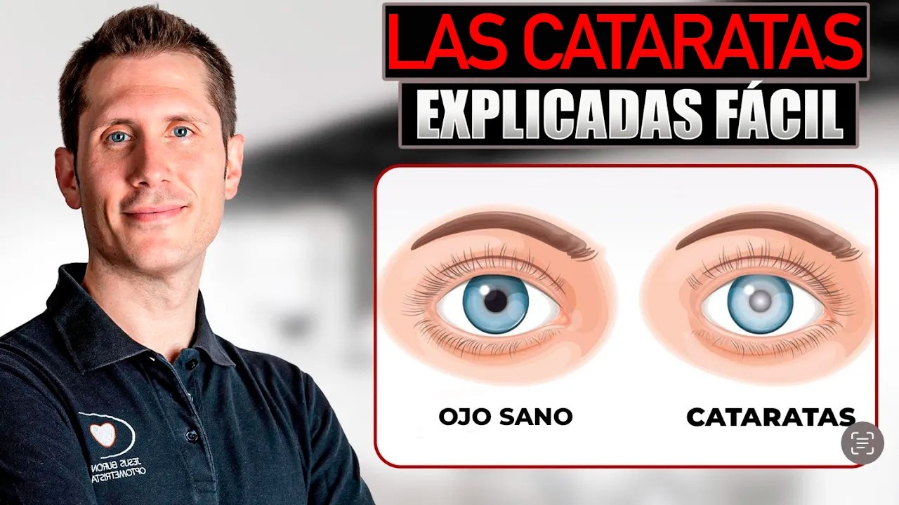 ✅ ¿Que son las CATARATAS de TUS OJOS?