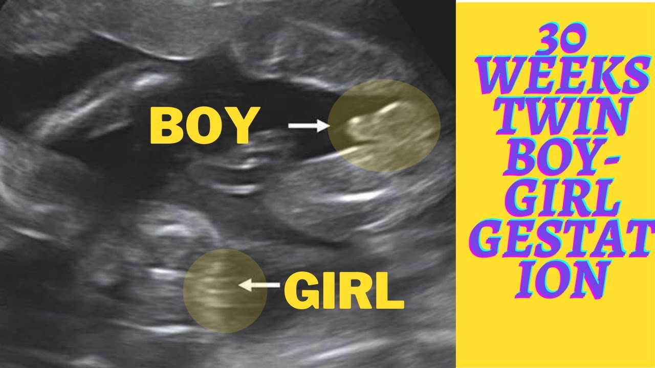 30 Weeks  Twin - Boy -Girl ! | Monochorionic Diamniotic Pregnancy | Ultrasound