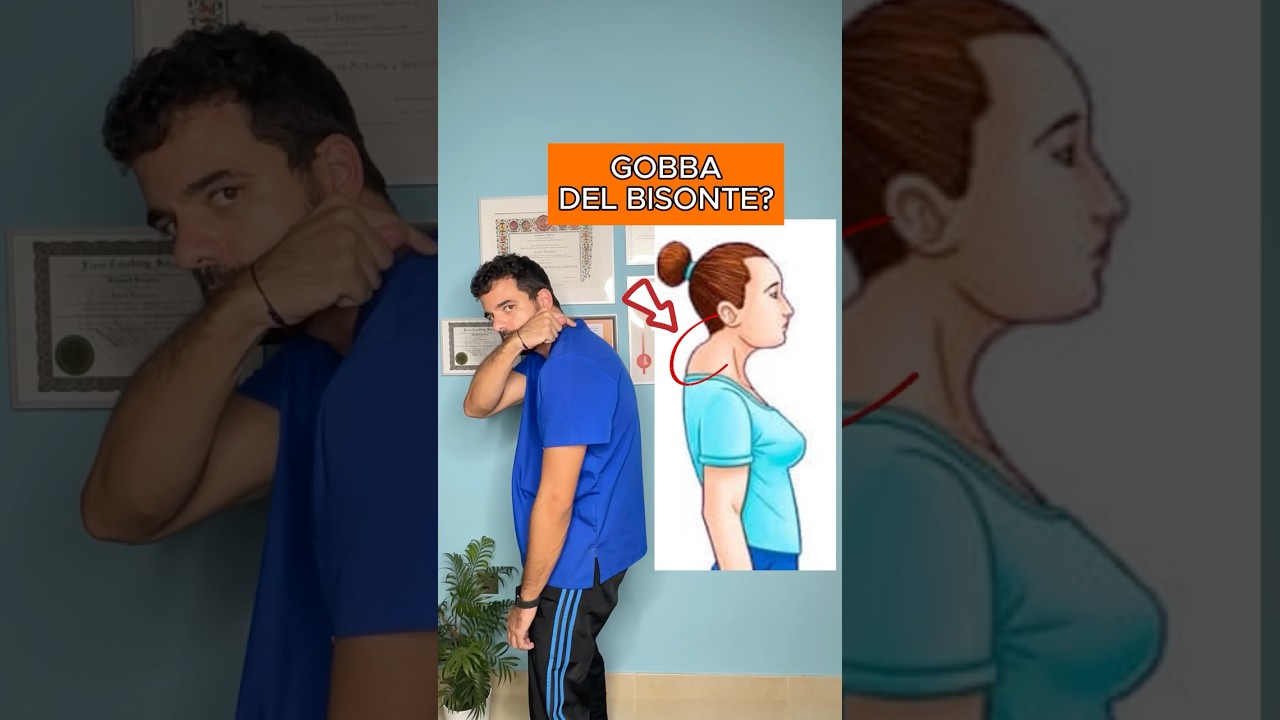 Gobba del Bisonte Esercizio Semplice del fisioterapista #gobba #cervicale #cervicalgia