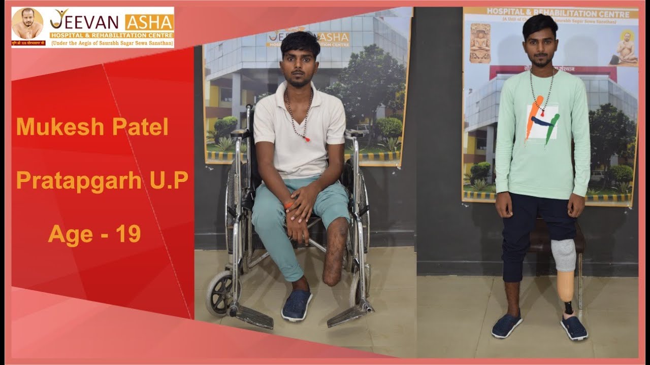Mukesh Patel lost his Left in a train accident.Jeevan Asha Hospital, free of cost Modular Prosthesis