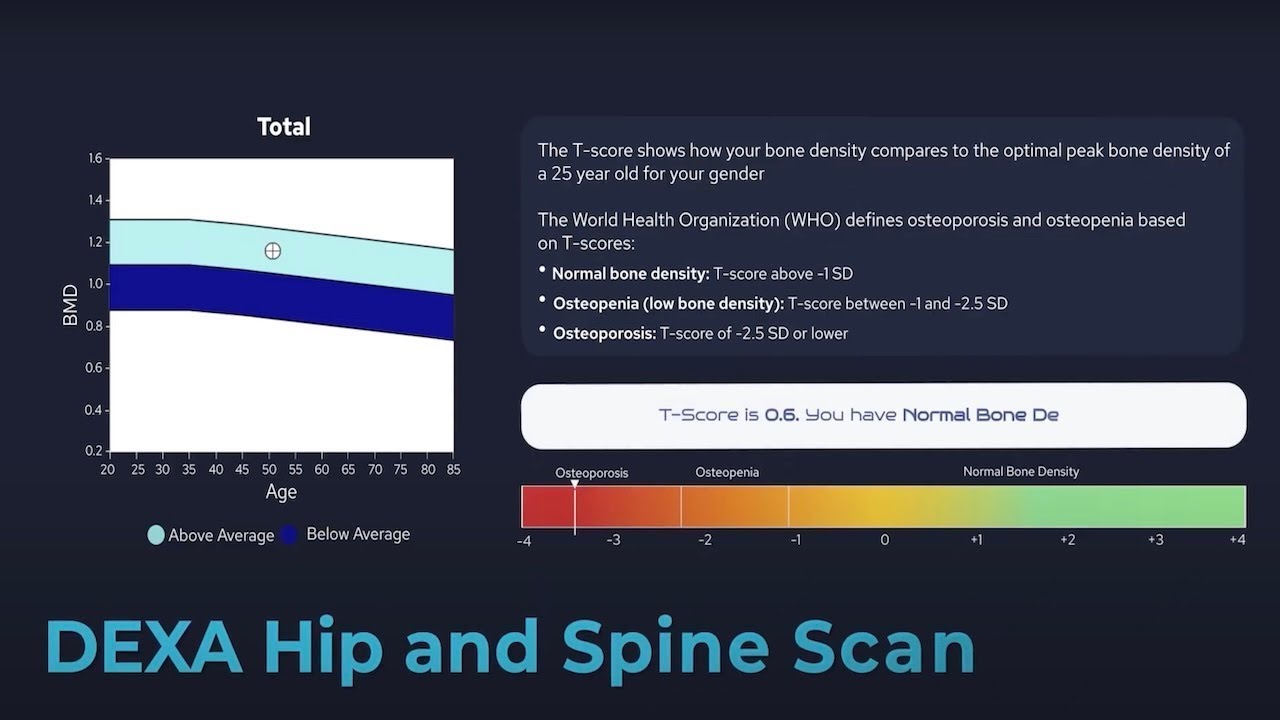Bodyscan Osteoporosis Dexa Scan