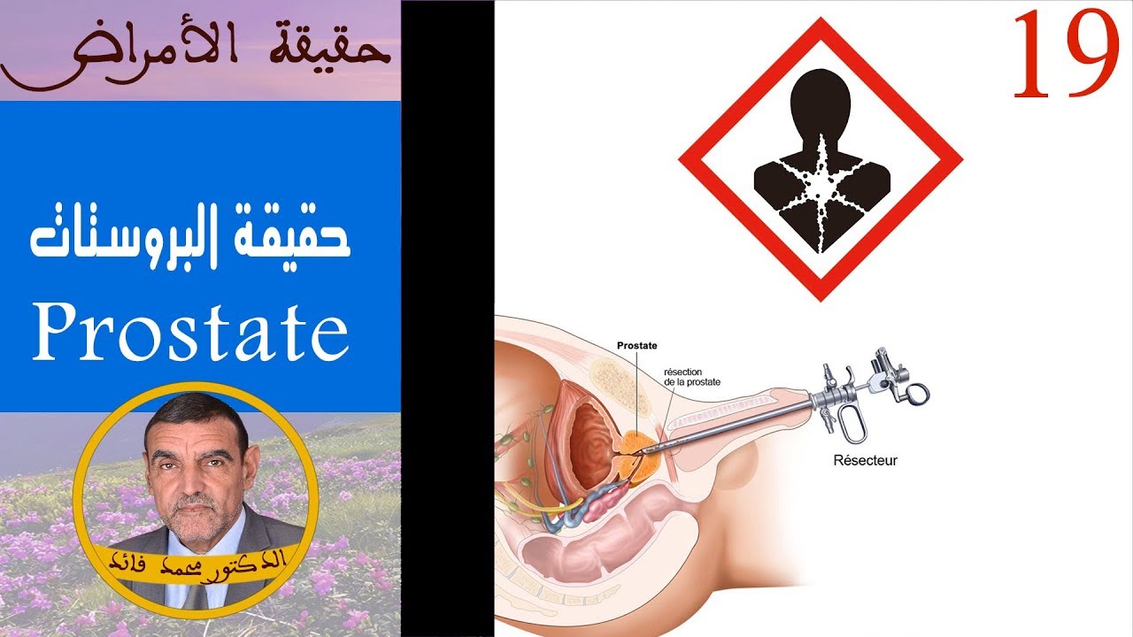 تضخم البروستاتا | الدكتور محمد فائد