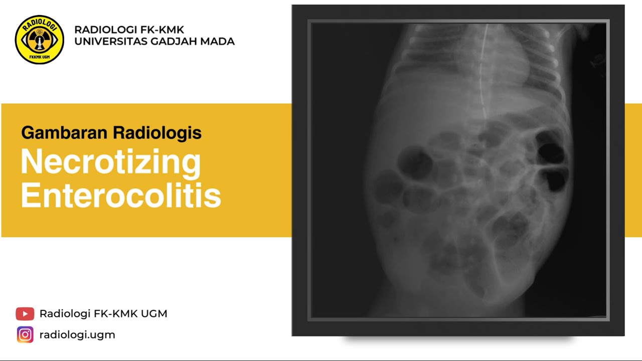 Necrotizing Enterocolitis