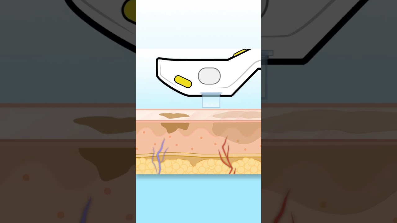 How does our new IPL Laser work?