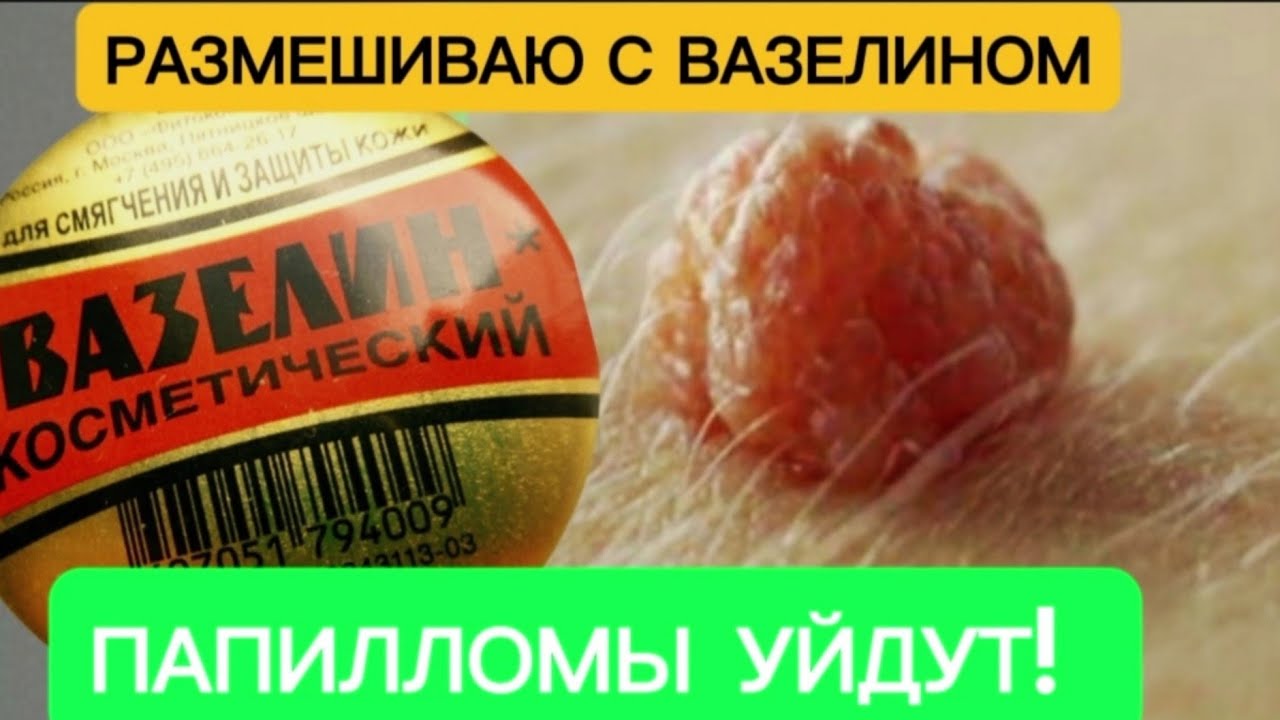 Бородавки, Папилломы и иные образования боятся этого средства
