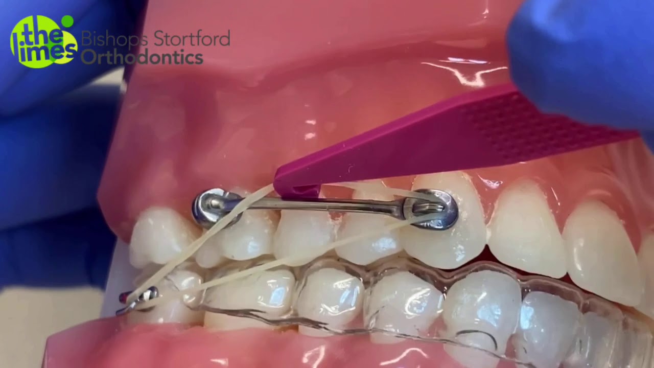 Elastics - Class II Carriere