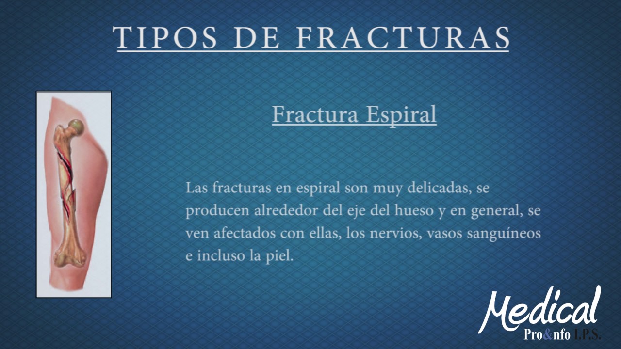 Tipos de Fracturas (Clínica Medica SAS)