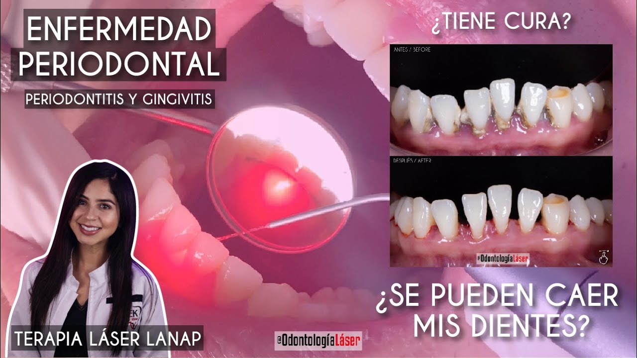 Enfermedad Periodontal, ¿Tiene cura? ¿Se pueden caer mis dientes? Terapia Lanap - Odontología Láser.