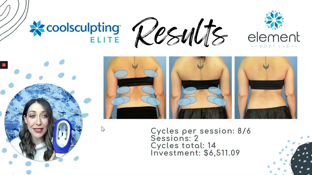 CoolSculpting Before and After | Back Fat | 2 Session Results | Element Body Lab | Dallas, Texas