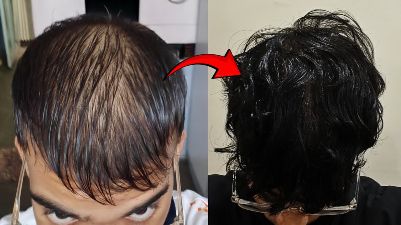 How To Stop Hair Thinning ( Reverse Your Hairloss)